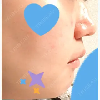 31日目の経過画像（1枚目）