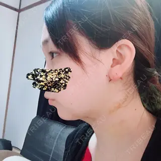 3日目の経過画像（1枚目）
