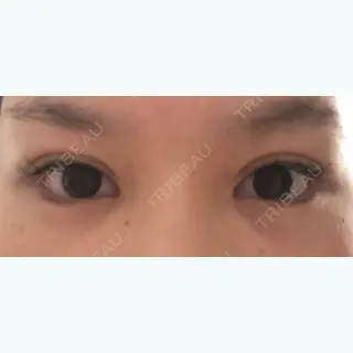 34日目の経過画像（1枚目）