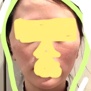 1日目の経過画像（1枚目）