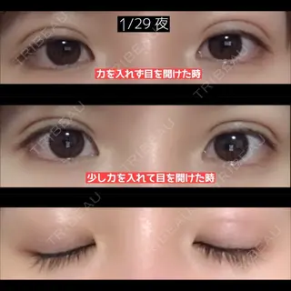 5日目の経過画像（2枚目）