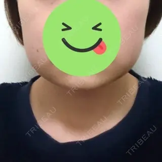 7日目の経過画像（1枚目）