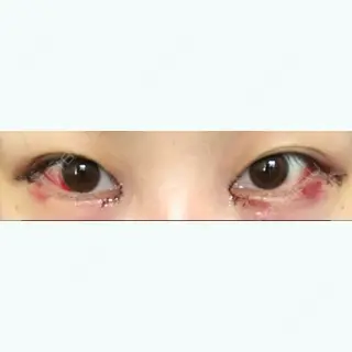 0日目の経過画像（1枚目）