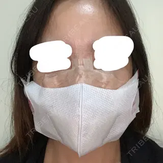 1日目の経過画像（3枚目）