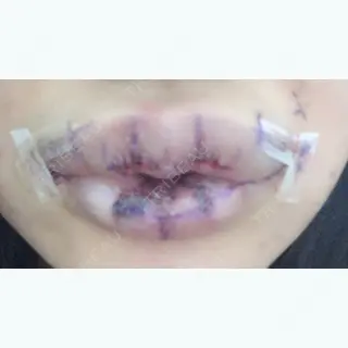 0日目の経過画像（1枚目）