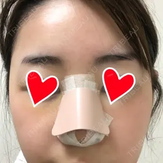 4日目の経過画像（1枚目）