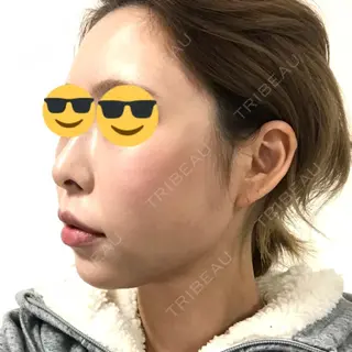 31日目の経過画像（1枚目）