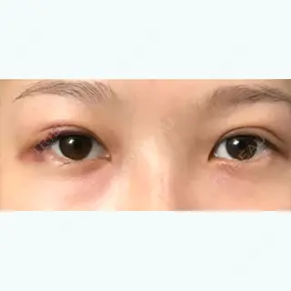 2日目の経過画像（1枚目）