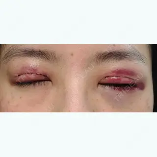 1日目の経過画像（2枚目）