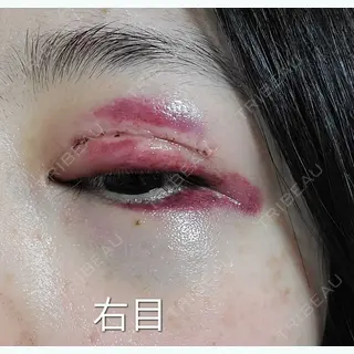 1日目の経過画像（3枚目）