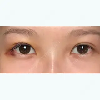 3日目の経過画像（1枚目）