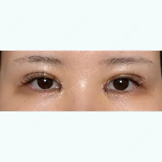 5日目の経過画像（1枚目）