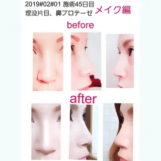 45日目の経過画像（1枚目）