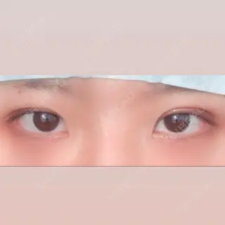 0日目の経過画像（1枚目）