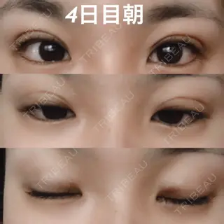 4日目の経過画像（1枚目）