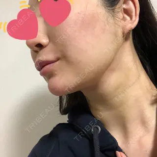 5日目の経過画像（1枚目）