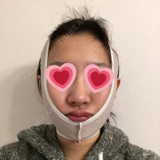 0日目の経過画像（3枚目）