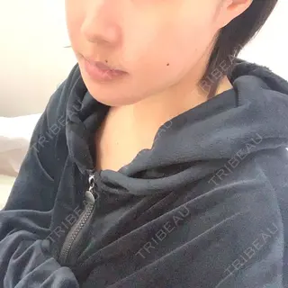3日目の経過画像（2枚目）