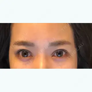 95日目の経過画像（2枚目）