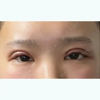 1日目の経過画像（1枚目）