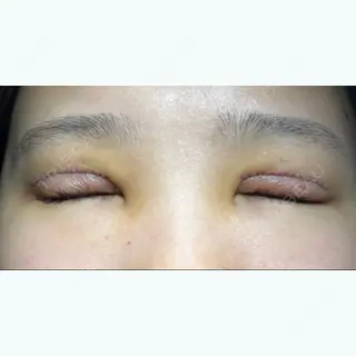 4日目の経過画像（2枚目）