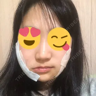 0日目の経過画像（1枚目）