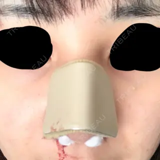 0日目の経過画像（1枚目）