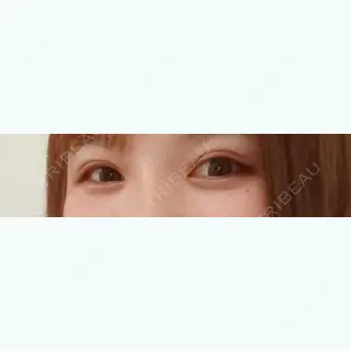 28日目の経過画像（1枚目）