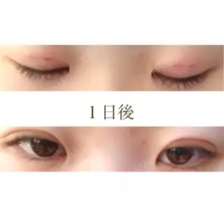 1日目の経過画像（1枚目）