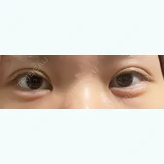 5日目の経過画像（1枚目）