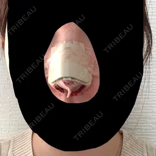0日目の経過画像（1枚目）