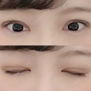 12日目の経過画像（1枚目）