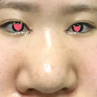 3日目の経過画像（1枚目）