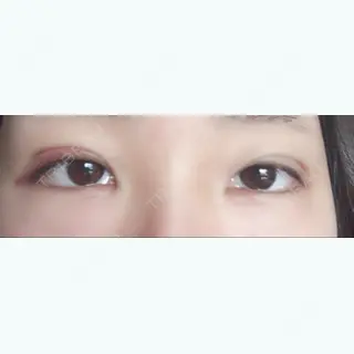 2日目の経過画像（1枚目）
