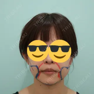 4日目の経過画像（1枚目）
