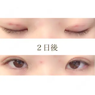 2日目の経過画像（1枚目）