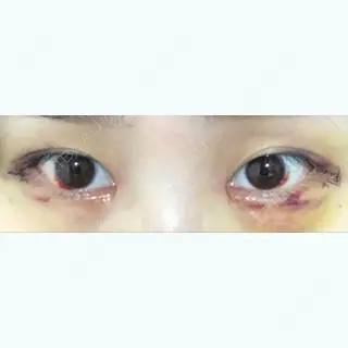 6日目の経過画像（1枚目）