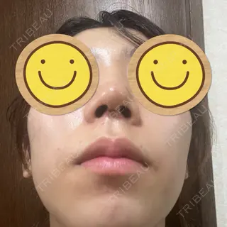 5日目の経過画像（2枚目）