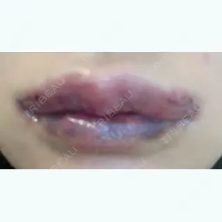 4日目の経過画像（1枚目）