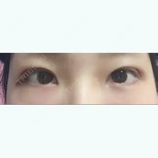 2日目の経過画像（1枚目）