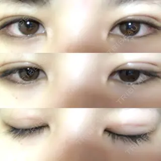 4日目の経過画像（1枚目）