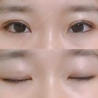 6日目の経過画像（1枚目）