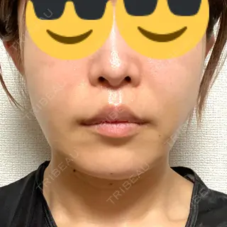 14日目の経過画像（1枚目）