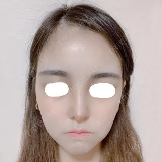 6日目の経過画像（2枚目）