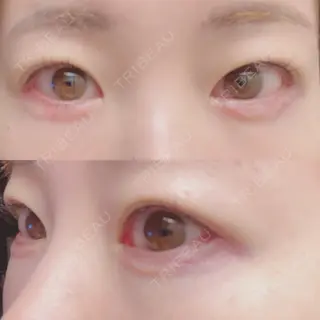 1日目の経過画像（1枚目）