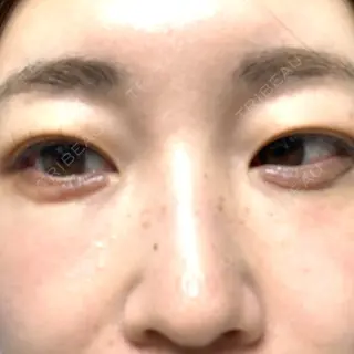 4日目の経過画像（1枚目）