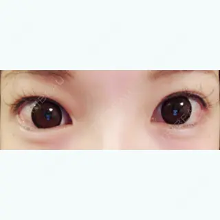 11日目の経過画像（1枚目）