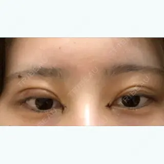 5日目の経過画像（1枚目）