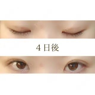 4日目の経過画像（1枚目）