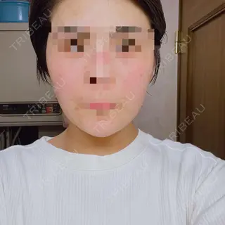 3日目の経過画像（1枚目）